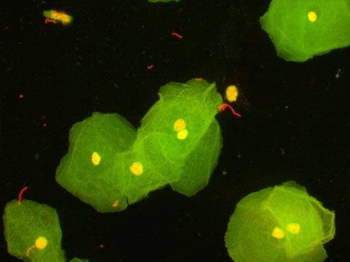 荧光显微镜下的妇科真菌是什么样子？